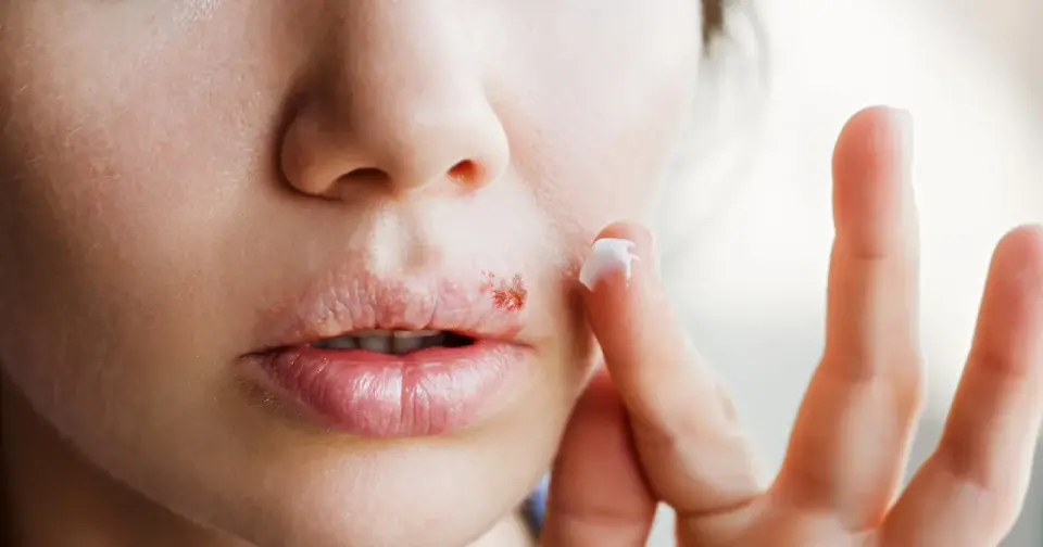 Herpes - dlaczego wraca? Objawy, leczenie i zapobieganie