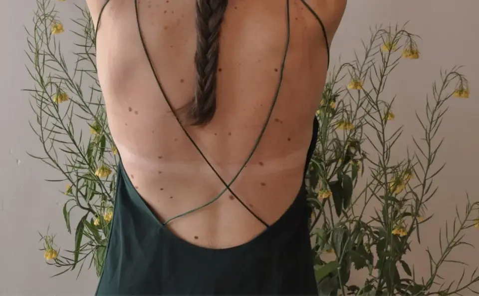 Nagły wysyp znamion - Kiedy iść do dermatologa?