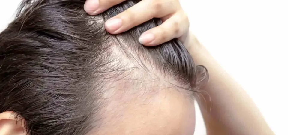 Alopecia da stress? Tempi, segnali e cosa controllare