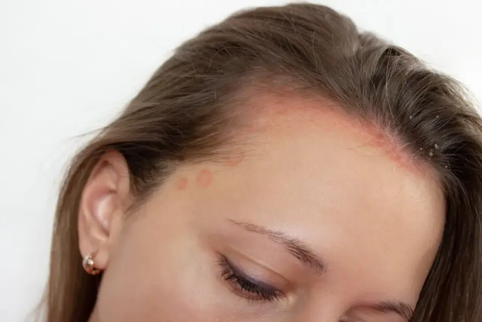 Dermatitis seborreica - Calma tu cuero cabelludo sin dañarlo