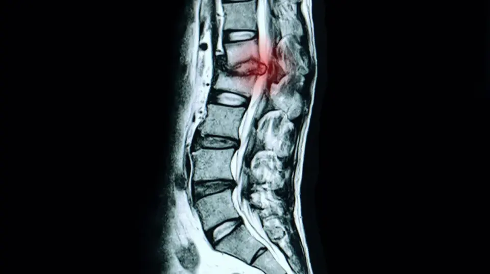 Bandscheibenprotrusion in der LWS - was wirklich hilft