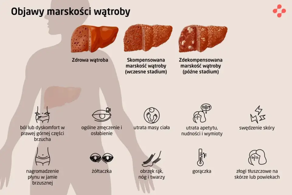Marskość wątroby - objawy somatyczne. Zobacz, co Ci grozi!