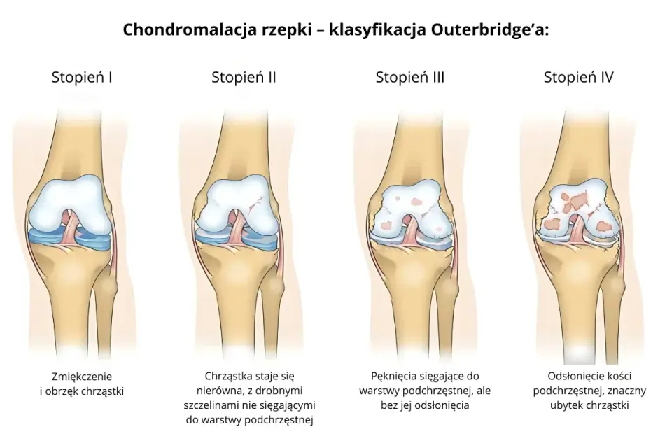 Chondromalacja rzepki - Ruch czy bezruch? Ćwicz bez bólu!