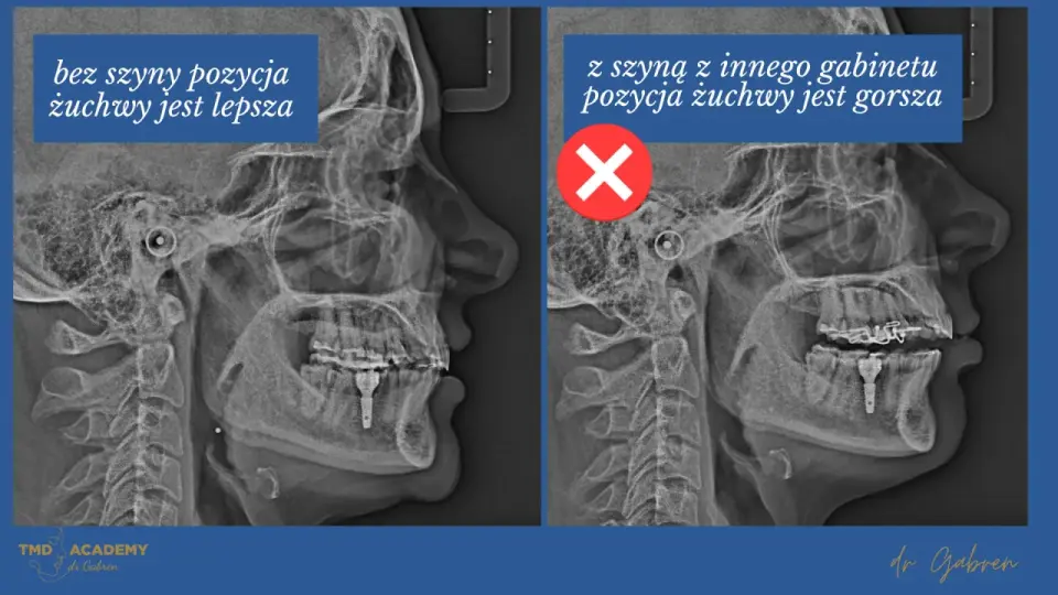 Szyna Michigan przy bruksizmie - jak działa i kiedy ma sens?