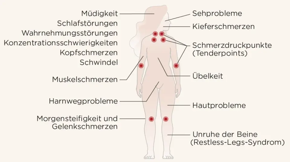 Fibromyalgie und Tender Points - worauf es bei der Diagnose ankommt