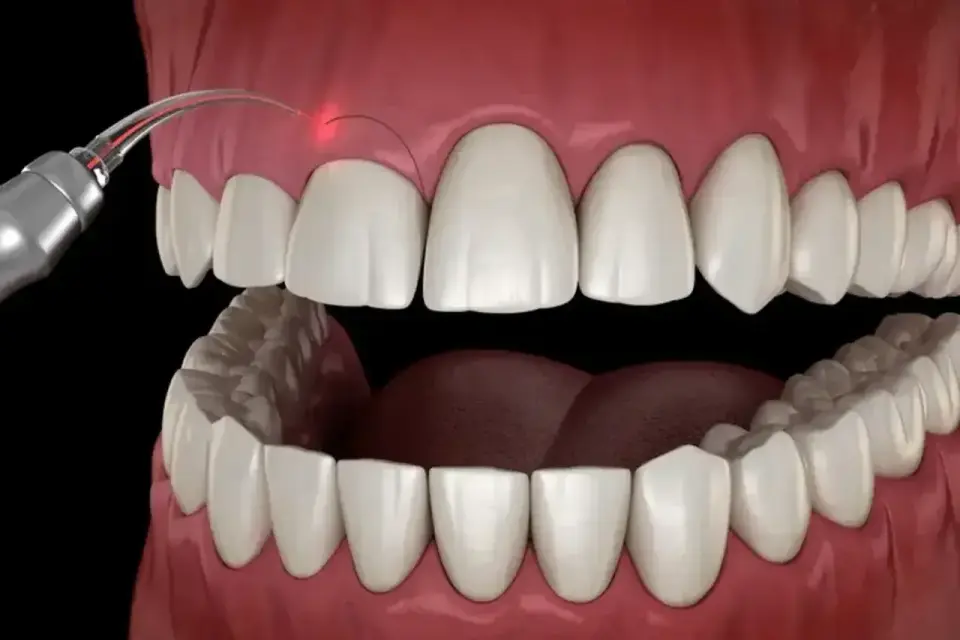Gingiwektomia - kiedy ma sens, jak wygląda i ile kosztuje?