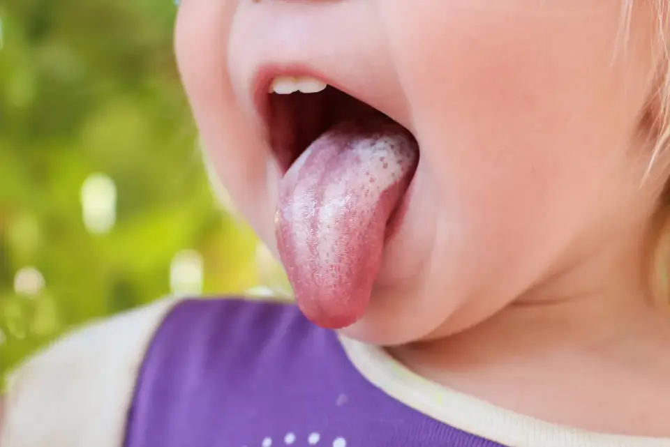 Hongos en la boca en un niño de 2 años - señales y qué hacer
