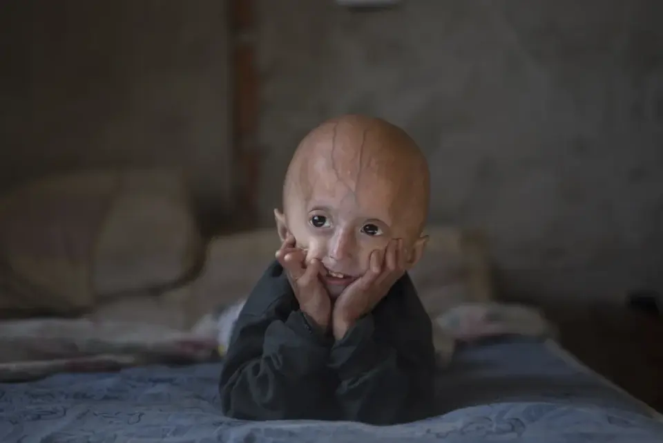 Progeria - Zespół Hutchinsona-Gilforda - objawy, diagnoza, opieka