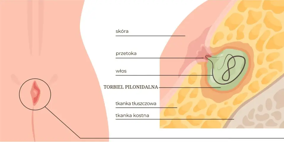 Torbiel włosowa - objawy, które łatwo przeoczyć i kiedy działać