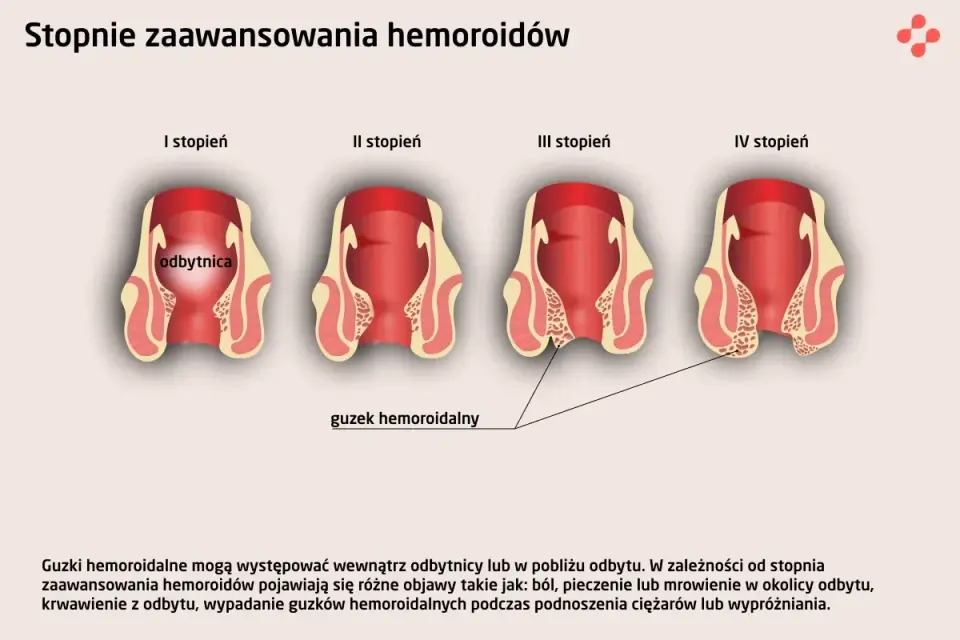 Wypadanie odbytu - Czy to hemoroidy? Objawy i leczenie!