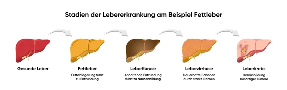 Fettleber Symptome erkennen und gezielt gegensteuern