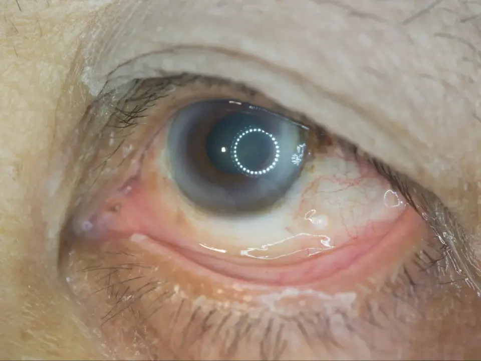 Retinopatia cukrzycowa - Jak rozpoznać objawy i chronić wzrok?