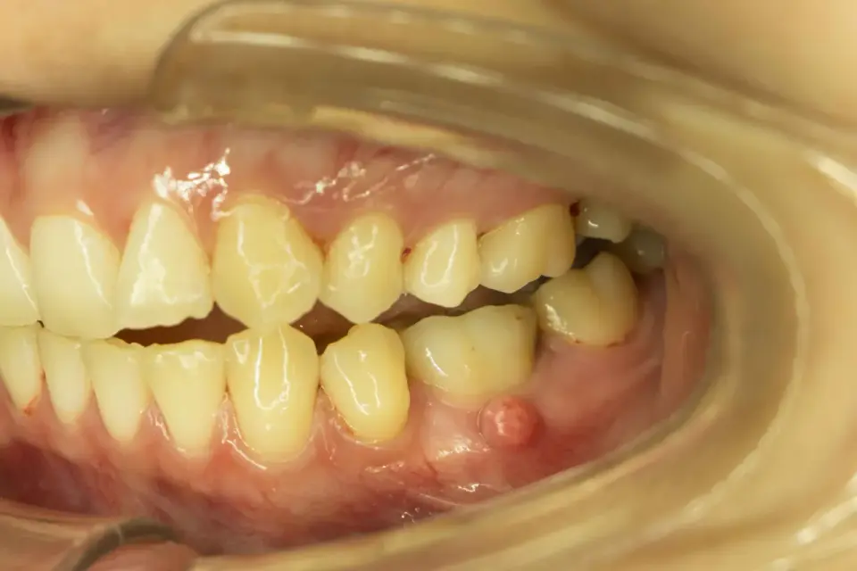 Ropień na dziąśle - co pomaga i kiedy pilnie iść do dentysty?