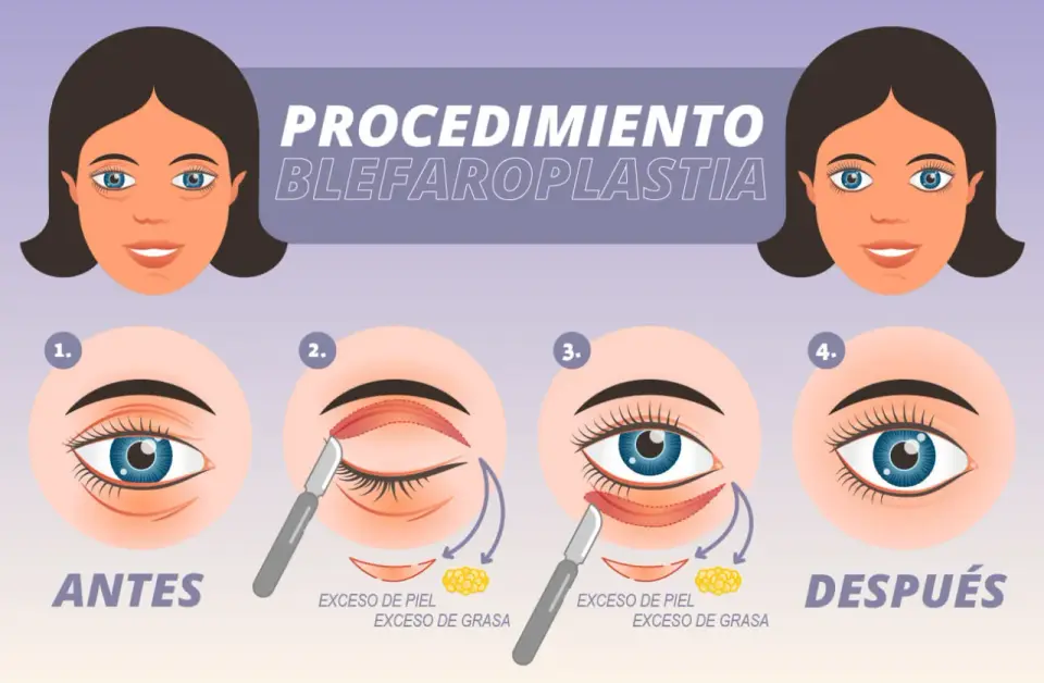 Blefaroplastia - Párpados caídos: ¿Qué corrige y cuánto cuesta?