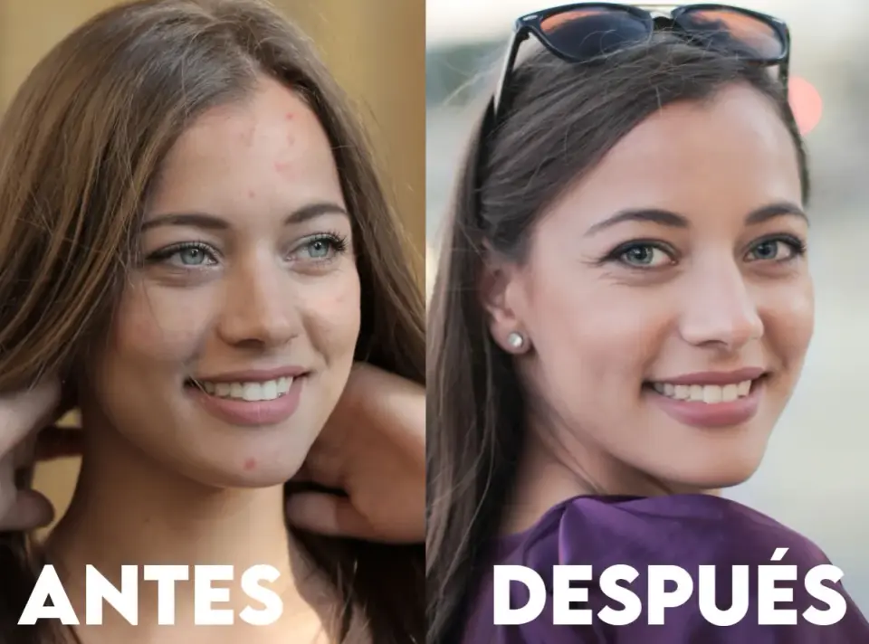 Deripil para acné - ¿Funciona? Guía de uso y efectos