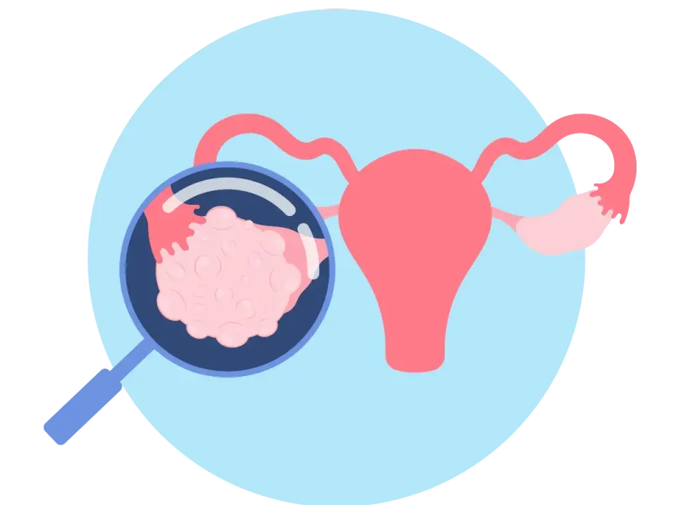 PCOS - Czy to tylko jajniki? Objawy, diagnostyka, leczenie