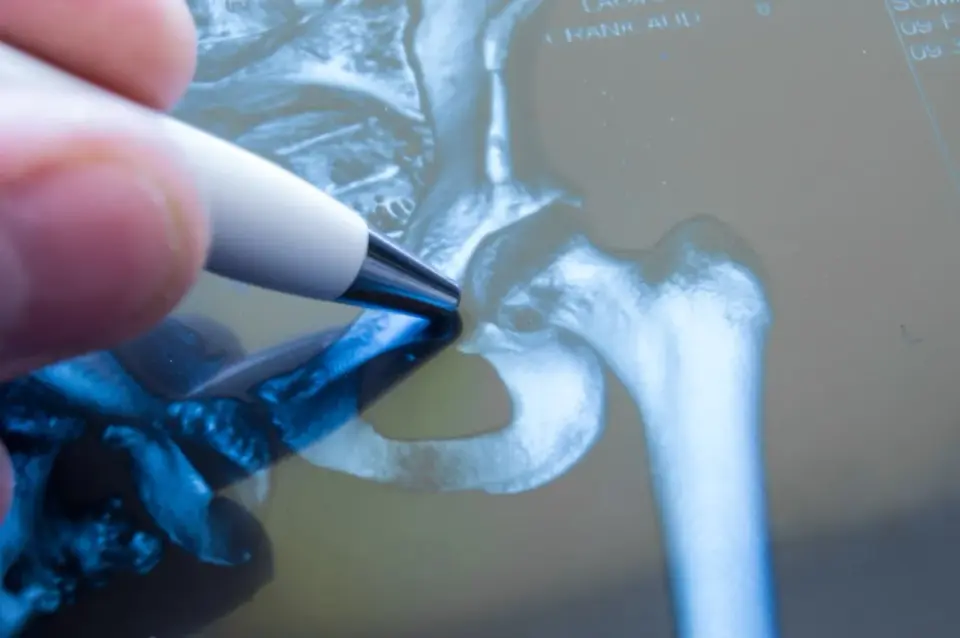 Bakteryjne zapalenie stawu biodrowego - pilna diagnoza i leczenie