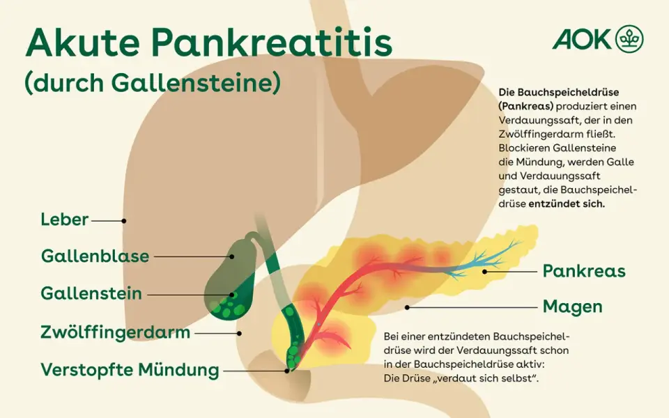 Pankreatitis-Symptome erkennen - diese Warnsignale zählen