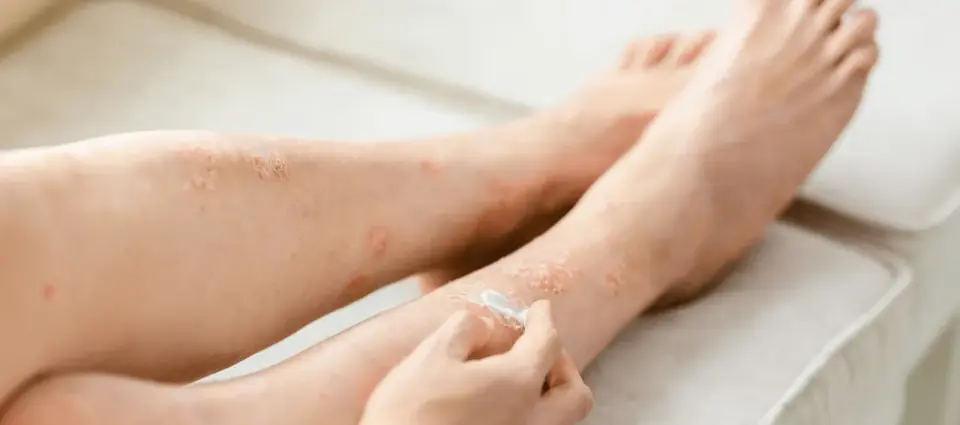 Locoid Lipocream - jak stosować go bezpiecznie i bez błędów?
