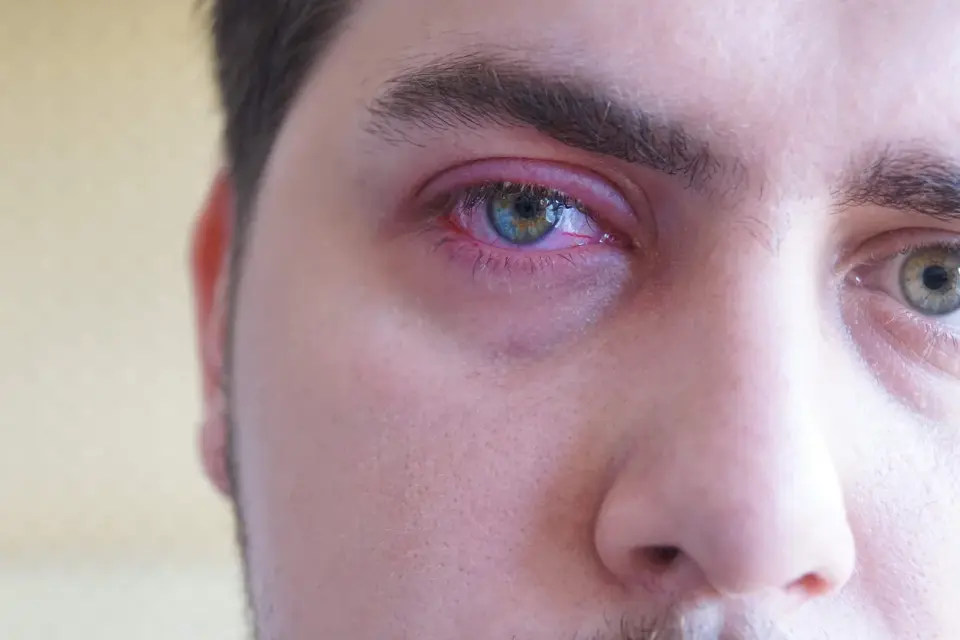Bolita en la línea de agua del ojo - ¿Qué es y cómo actuar?