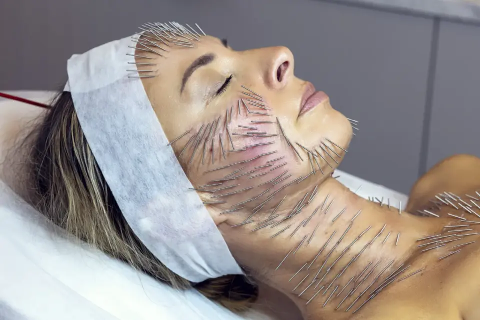 Needle shaping - naturalny lifting bez wypełniaczy