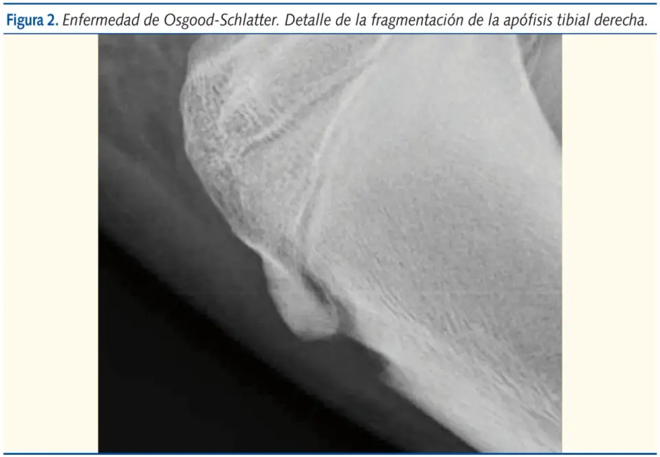Osgood-Schlatter en niños y adolescentes - señales y cuidados