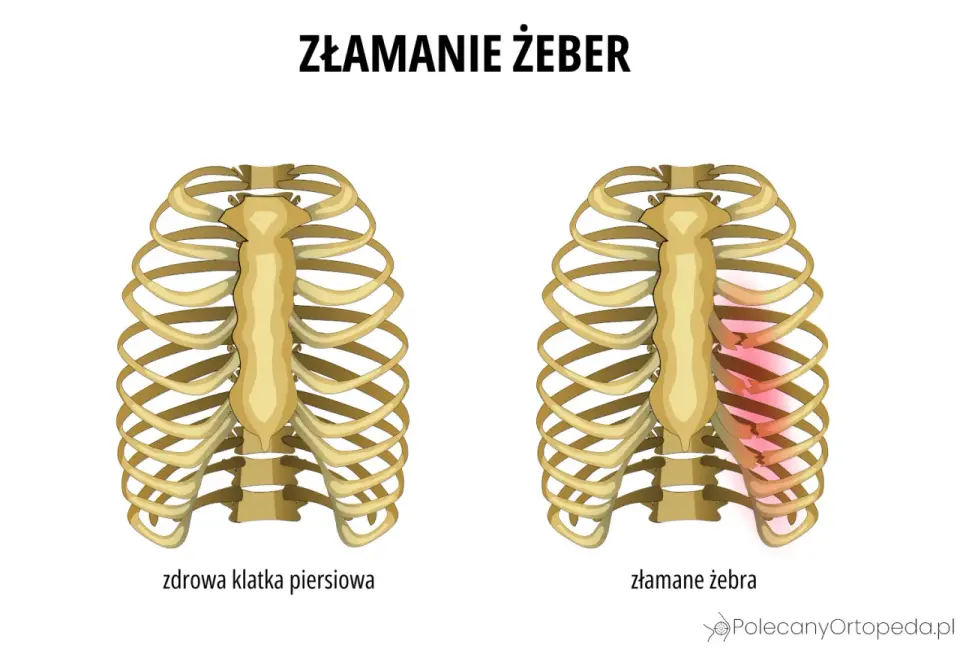 Stłuczone żebra bez siniaka - Co robić? Kiedy do lekarza?