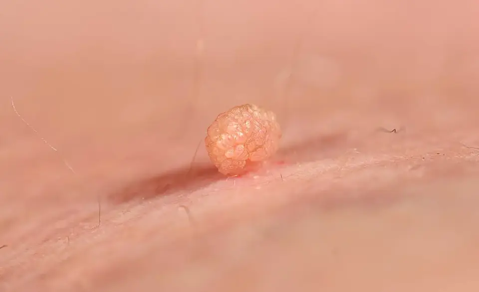 HPV objawy - kłykciny kończyste. Czy to na pewno HPV?